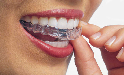 Invisalign