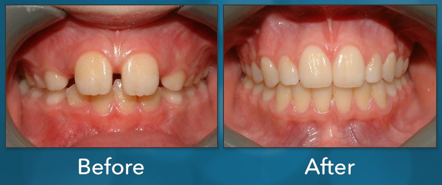 Orthodontic treatment before and after