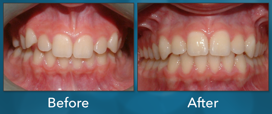 Orthodontic treatment before and after