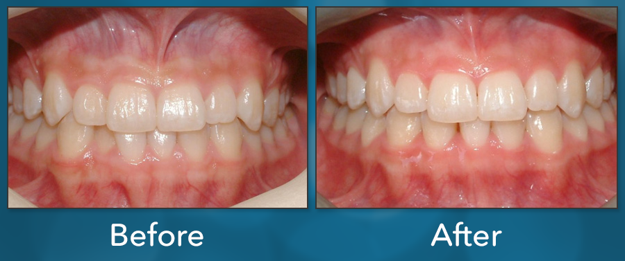 Orthodontic treatment before and after