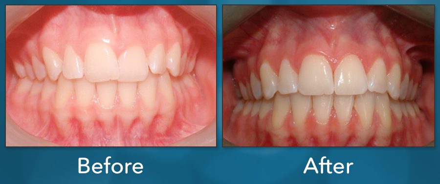 Orthodontic treatment before and after