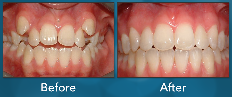 Orthodontic treatment before and after