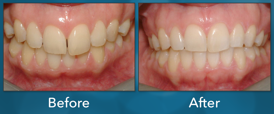 Orthodontic treatment before and after