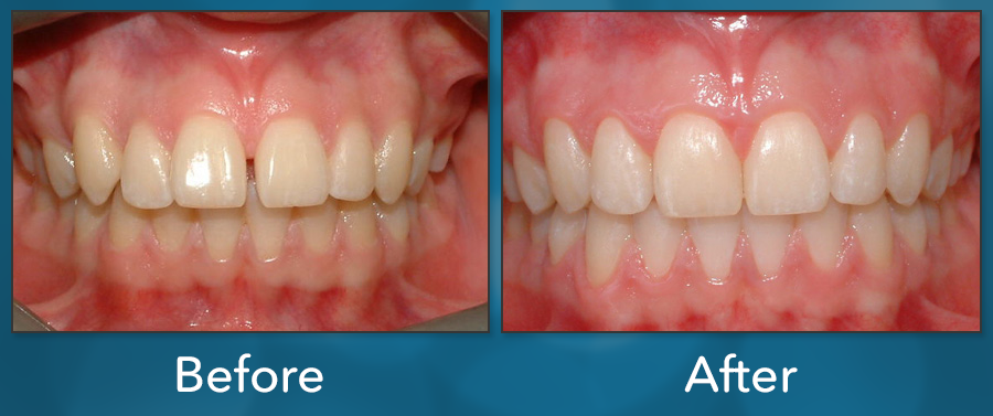 Orthodontic treatment before and after