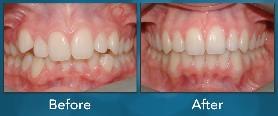 Orthodontic treatment before and after