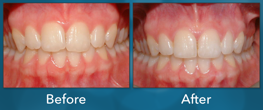 Orthodontic treatment before and after