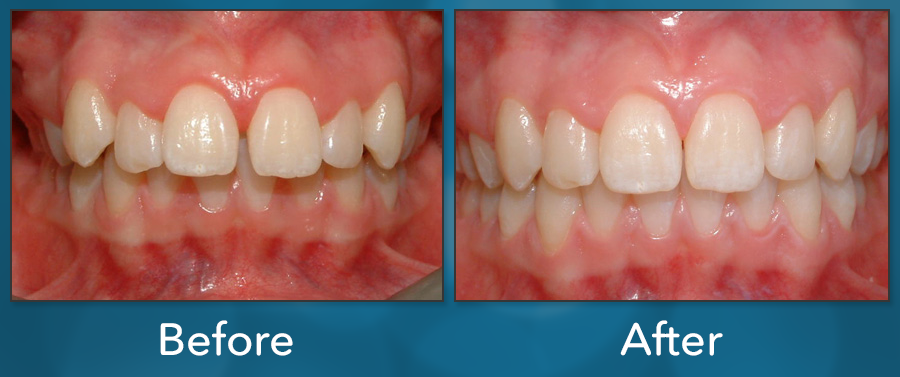 Orthodontic treatment before and after